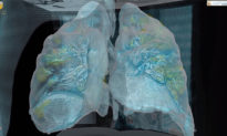Video 3D về tổn thương phổi của bệnh nhân nhiễm virus Corona Vũ Hán