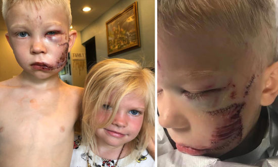 Mạo hiểm cứu em gái khỏi chó cắn, cậu bé 6 tuổi phải khâu 90 mũi trên mặt