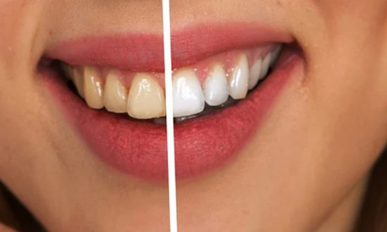 5 cách để răng trắng, cười xinh, ai nhìn cũng thích