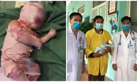 Bé sơ sinh da vảy cá ở Lào Cai đã hồi phục, được chỉ định xuất viện