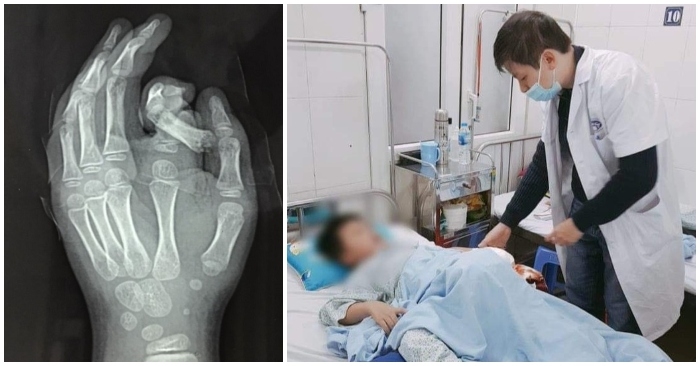 Cho tay vào máy giặt, ngón trỏ của bé trai 6 tuổi ở Hà Nội bị đứt rời, dập nát