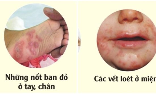 28 quận huyện ở Hà Nội xuất hiện bệnh tay chân miệng