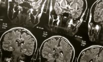COVID ảnh hưởng đến não bộ như thế nào? Hai nhà thần kinh học giải thích