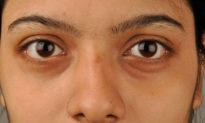 Tại sao mắt dễ xuất hiện quầng thâm? 5 phương pháp để giảm nếp nhăn và quầng mắt