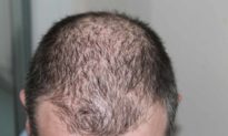 Thay đổi dầu gội đầu thường xuyên có thể gây rụng tóc, ăn gì để ngăn ngừa rụng tóc?