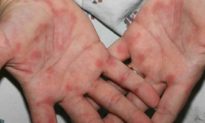 3 triệu chứng trên bàn tay - chân báo hiệu nguy cơ mắc bệnh về gan
