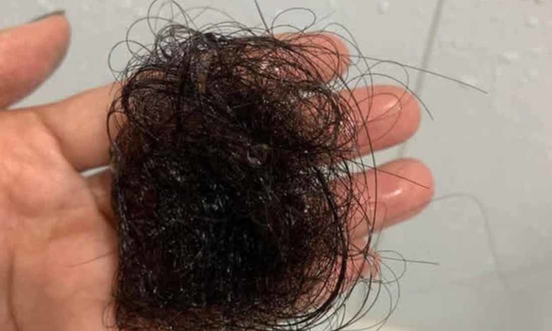 Rụng tóc ở nam tuổi 20: Nguyên nhân do đâu và điều trị thế nào?