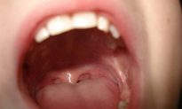 3 triệu chứng trên miệng báo hiệu dạ dày nhiễm vi khuẩn Helicobacter pylori