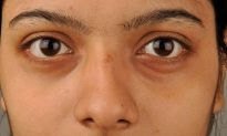 Quầng thâm mắt: Nguyên nhân và cách khắc phục