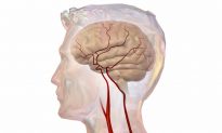 6 dấu hiệu cảnh báo nguy cơ nhồi máu não