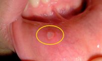 Phải làm gì nếu vết loét trong miệng xuất hiện kéo dài và lặp lại thường xuyên?