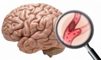 2 dấu hiệu cảnh báo nhồi máu não - 5 bí quyết để phòng ngừa và giảm thiểu nguy cơ