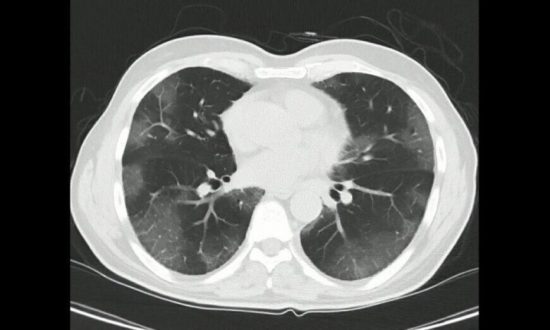 6 câu hỏi hàng đầu về hội chứng phổi trắng