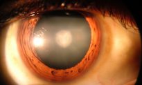 5 bệnh nhân bị mù sau khi dùng thuốc điều trị mất thị lực