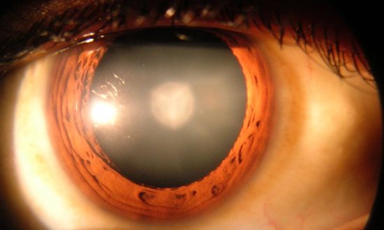 5 bệnh nhân bị mù sau khi dùng thuốc điều trị mất thị lực