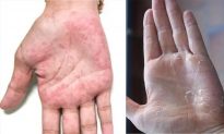 10 dấu hiệu trên bàn tay có thể tiết lộ tình trạng sức khoẻ