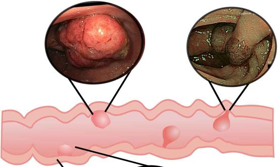 6 dấu hiệu nguy hiểm của ung thư đại trực tràng - Cách nhận biết có polyp gây bệnh trong ruột