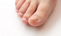 Móng chân bị nứt và giòn? Những lời khuyên giúp chống lại nhiễm nấm móng