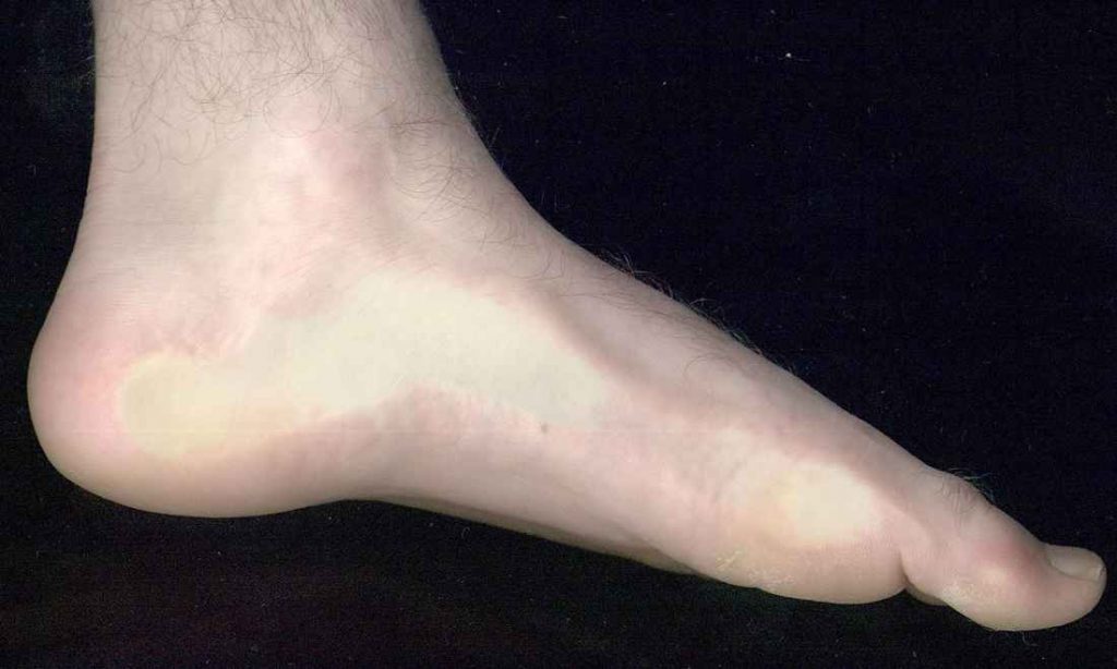 4 triệu chứng bất thường ở chân có thể là dấu hiệu của bệnh ung thư phổi