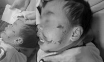 Phú Thọ: Bé trai 3 tuổi bị chó hàng xóm cắn rách mặt