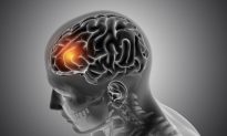 5 dấu hiệu cảnh báo nguy cơ xuất huyết não