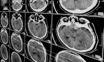 Nghiên cứu: Người sắp tử vong vì chấn thương sọ não vẫn có thể hồi phục