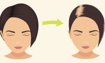 Hói đầu có thể chữa khỏi không? Nguyên nhân và cách điều trị rụng tóc theo Đông y
